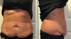 Body Contouring After Weight Loss