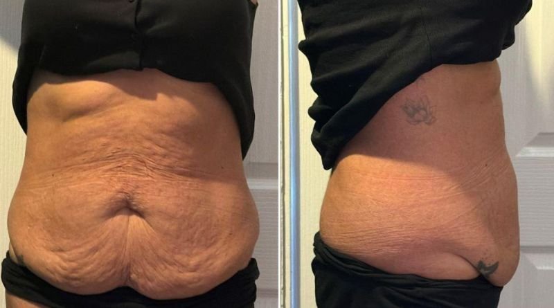 Body Contouring After Weight Loss