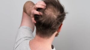 Hair Thinning In Men Common Causes, Early Clues, And Practical Next Steps